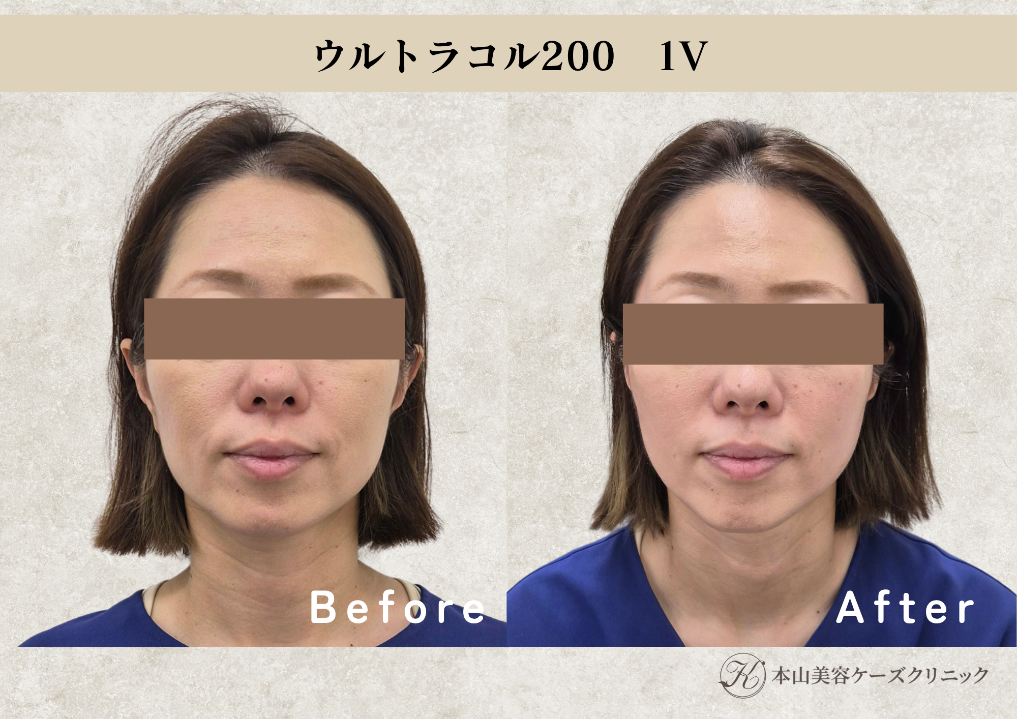 ウルトラコル200・1バイアル使用症例の施術前後写真